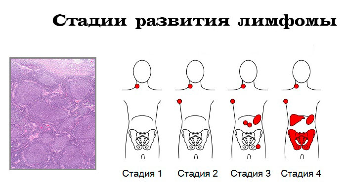стадии развития лимфомы