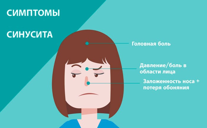 симптомы синусита