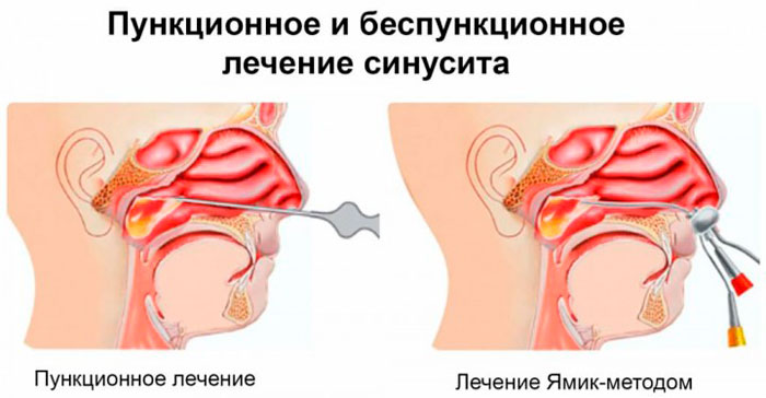 пункционное и беспункционное лечение