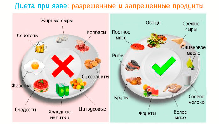 диета при язве желудка