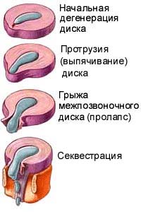 болезни позвоночника: протрузия, грыжа