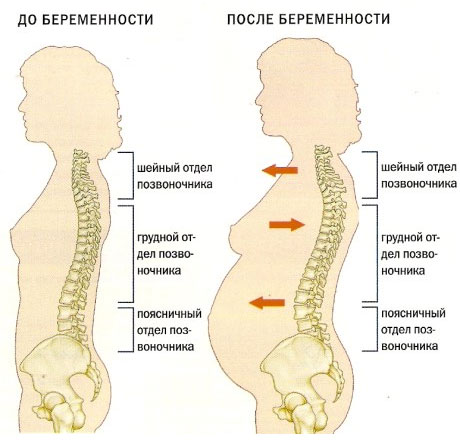 боли в спине при беременности