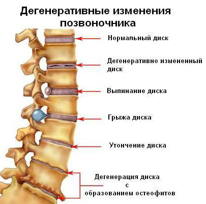 Дегенеративное изменение позвоночника