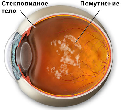 помутнение глаза