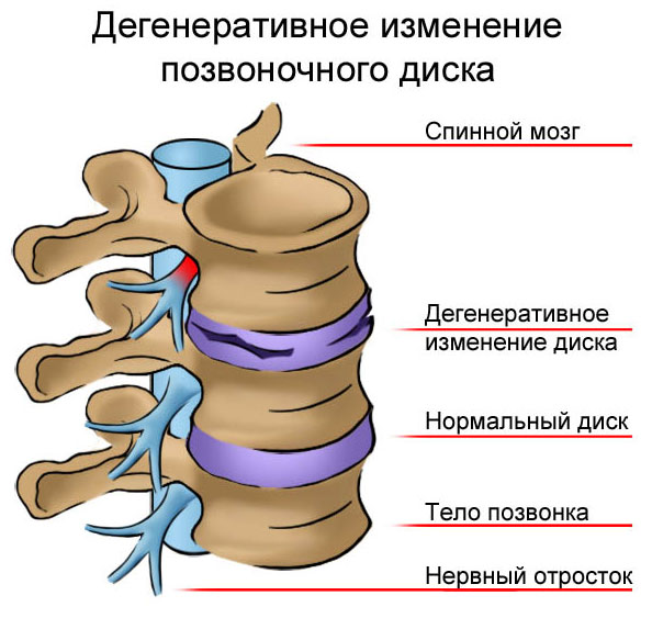 изменение позвоночного диска