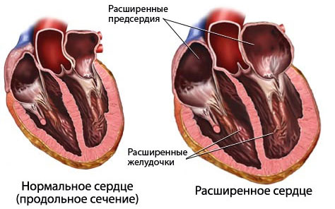 Болезнь кардиопатия