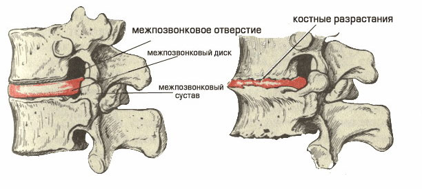 Осложнения при остеохондрозе