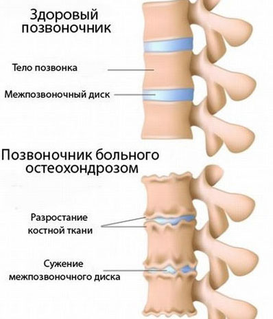 Остеохондроз позвоночника