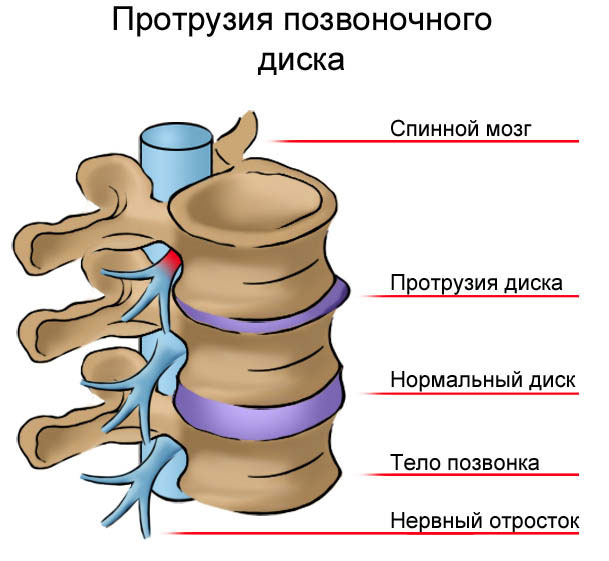 протрузия