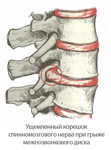 Корешковый синдром