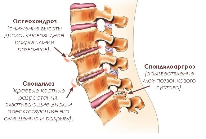 спондилез позвоночника