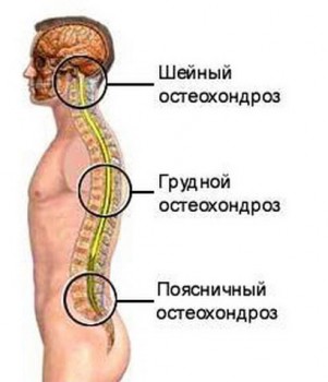 Три вида остеохондроза