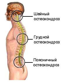 Виды остеохондроза