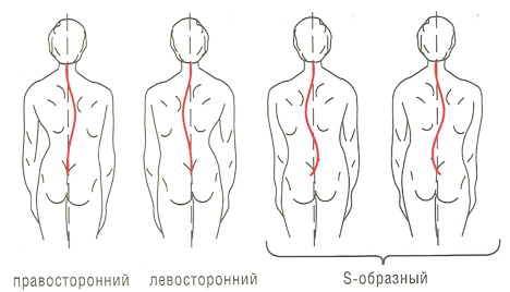 виды сколиоза
